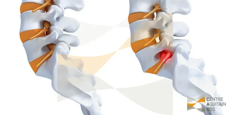 Spondylolisthésis