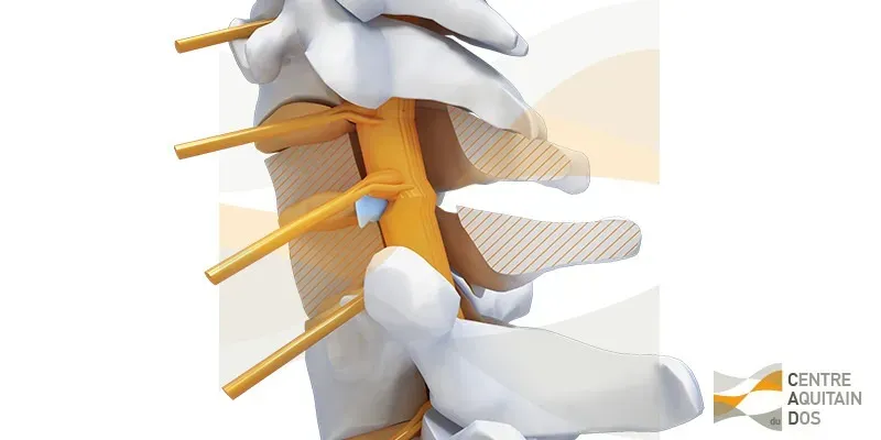 Hernie discale cervicale
