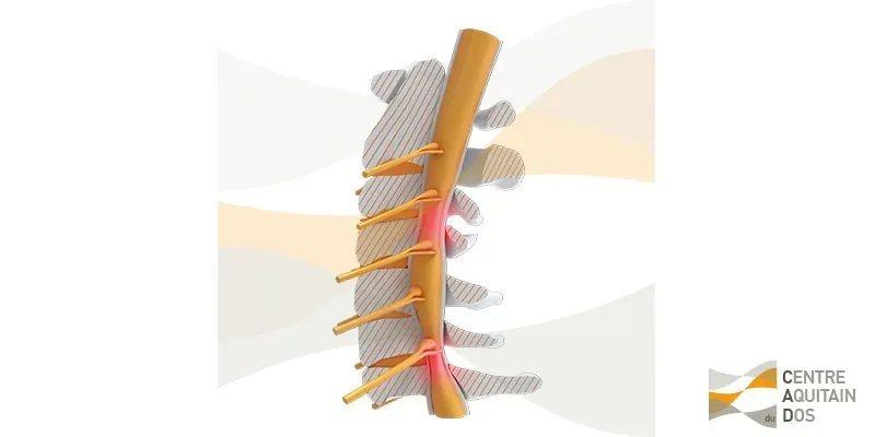 Myélopathie cervicarthrosique