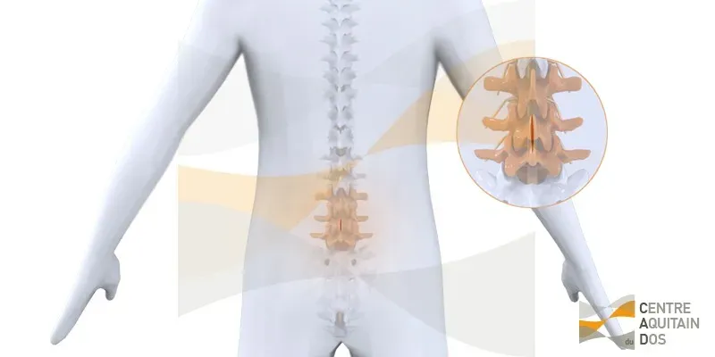 Chirurgie de la hernie discale lombaire