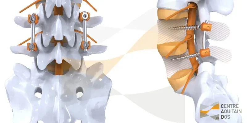Arthrodèse lombaire par voie postérieure