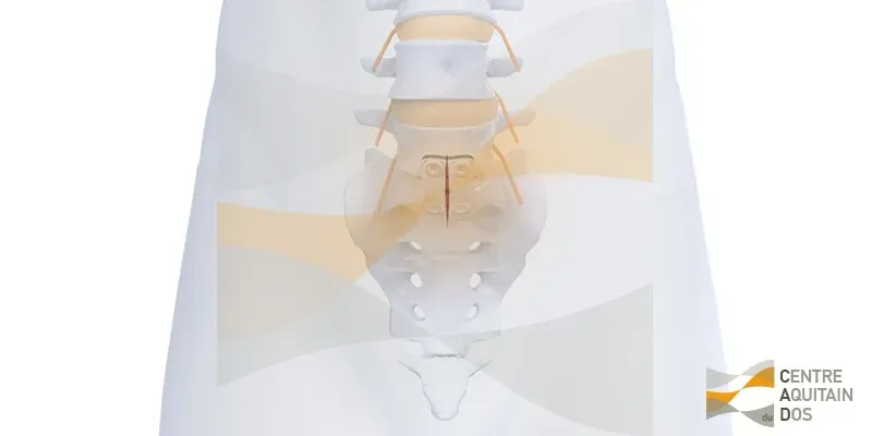Arthrodèse lombaire mini-invasive par voie antérieure