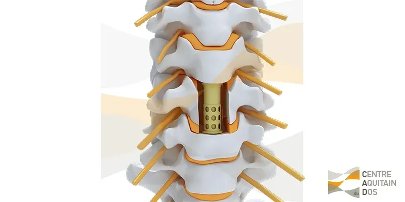 Corporectomie cervicale