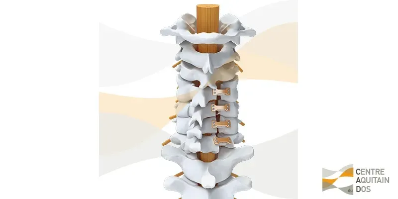 CAD_interventions_11_Laminaplastie_synthes3d_v1_web_filigrane