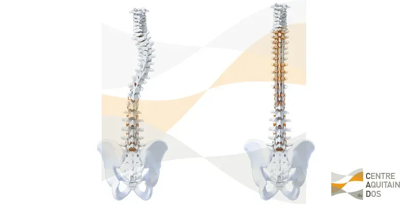 Chirurgie de la scoliose de l’adolescent